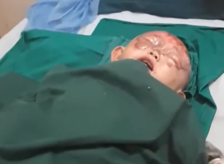 Lặng người trước bé 2 tuổi bị bỏng nặng vì tai nạn bất ngờ